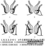 高低位肛瘘示意图